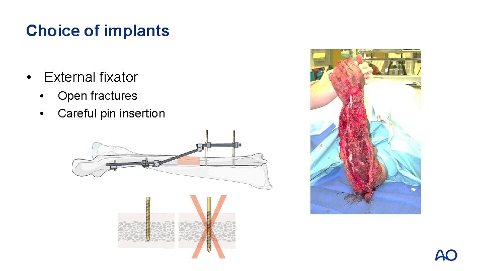 Choice of implants • External fixator • • Open fractures Careful pin insertion 