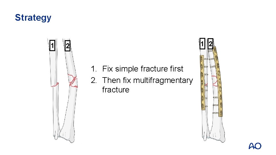 Strategy 1 1 2 2 1. Fix simple fracture first 2. Then fix multifragmentary
