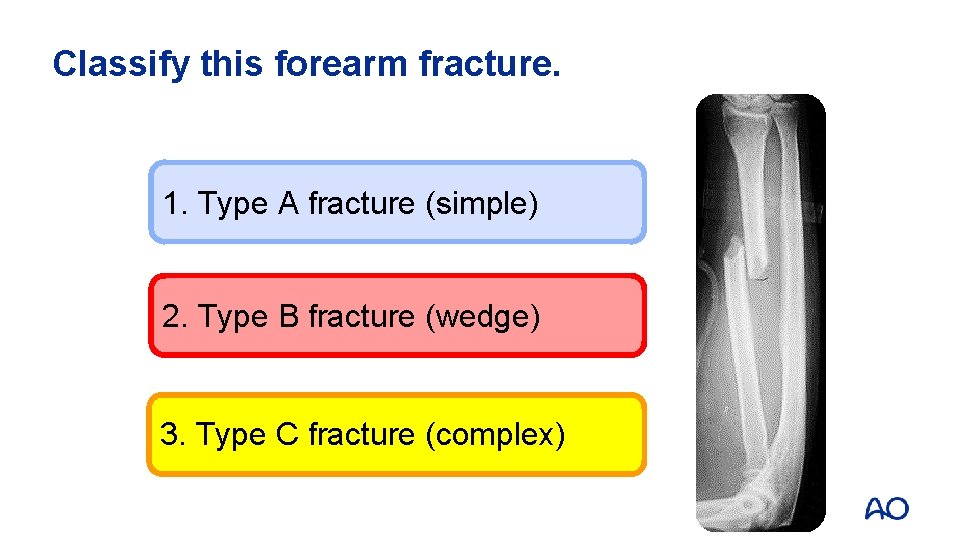 Classify this forearm fracture. 1. Type A fracture (simple) 2. Type B fracture (wedge)
