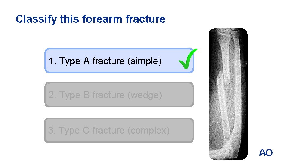 Classify this forearm fracture 1. Type A fracture (simple) 2. Type B fracture (wedge)