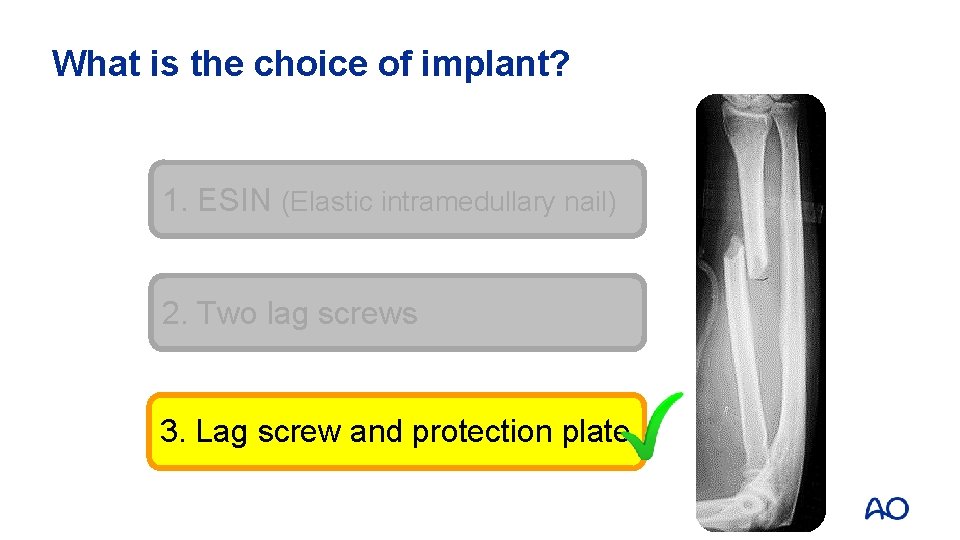 What is the choice of implant? 1. ESIN (Elastic intramedullary nail) 2. Two lag