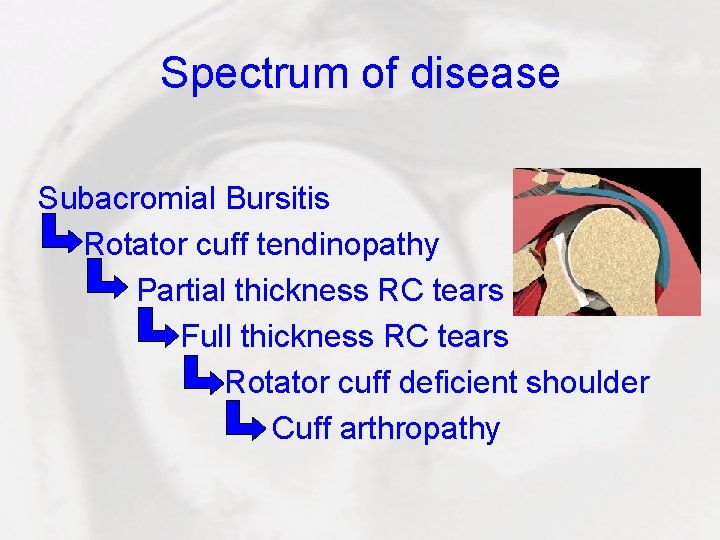 Spectrum of disease Subacromial Bursitis Rotator cuff tendinopathy Partial thickness RC tears Full thickness