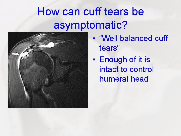 How can cuff tears be asymptomatic? • “Well balanced cuff tears” • Enough of