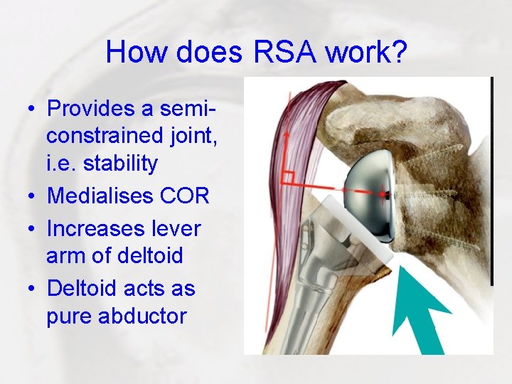 How does RSA work? • Provides a semiconstrained joint, i. e. stability • Medialises