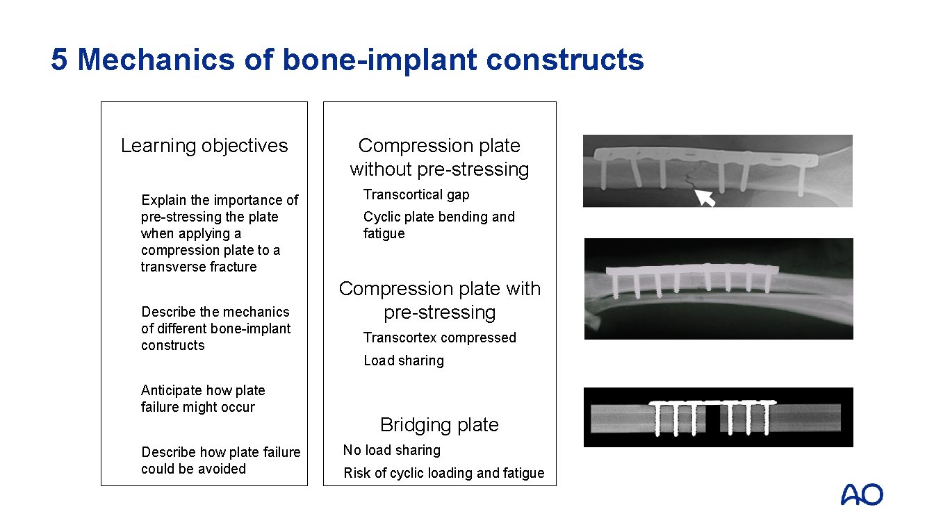 5 Mechanics of bone-implant constructs Learning objectives Explain the importance of pre-stressing the plate
