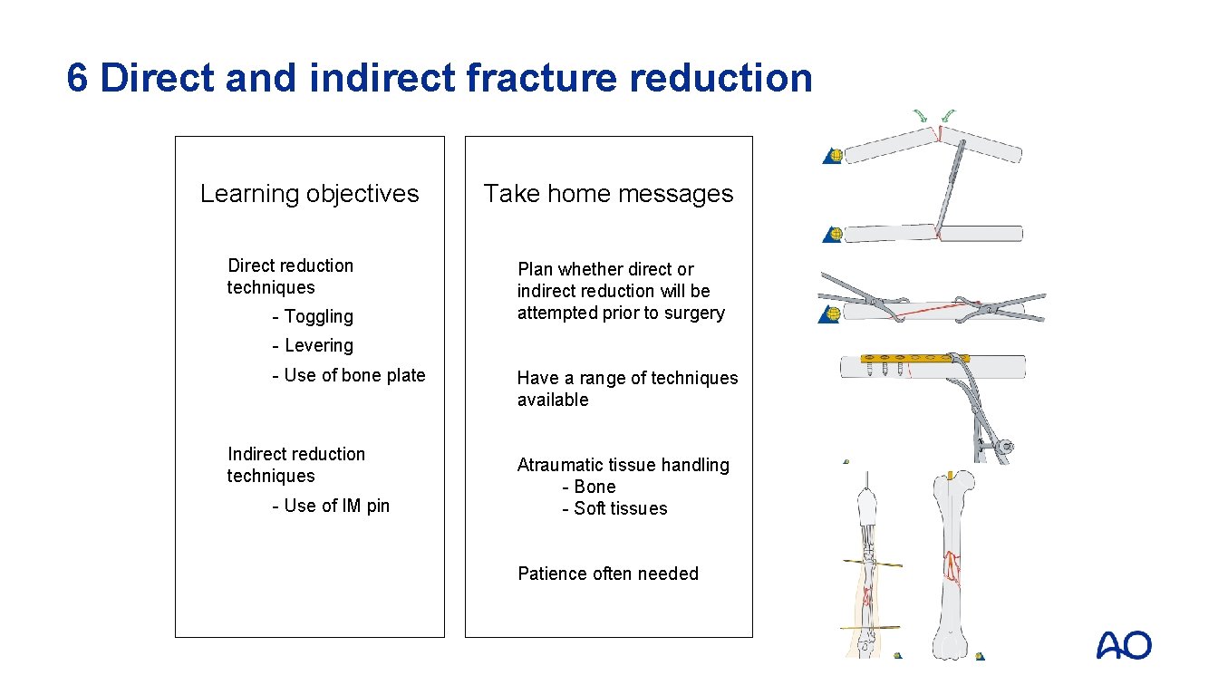 6 Direct and indirect fracture reduction Learning objectives Direct reduction techniques - Toggling Take