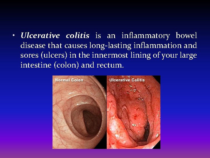  • Ulcerative colitis is an inflammatory bowel disease that causes long-lasting inflammation and