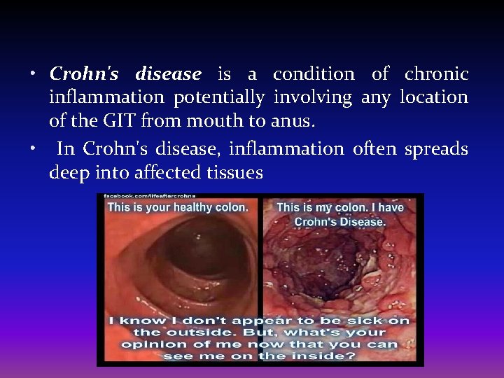  • Crohn's disease is a condition of chronic inflammation potentially involving any location