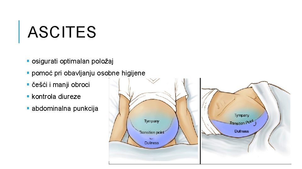 ASCITES § osigurati optimalan položaj § pomoć pri obavljanju osobne higijene § češći i