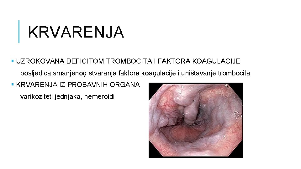 KRVARENJA § UZROKOVANA DEFICITOM TROMBOCITA I FAKTORA KOAGULACIJE posljedica smanjenog stvaranja faktora koagulacije i