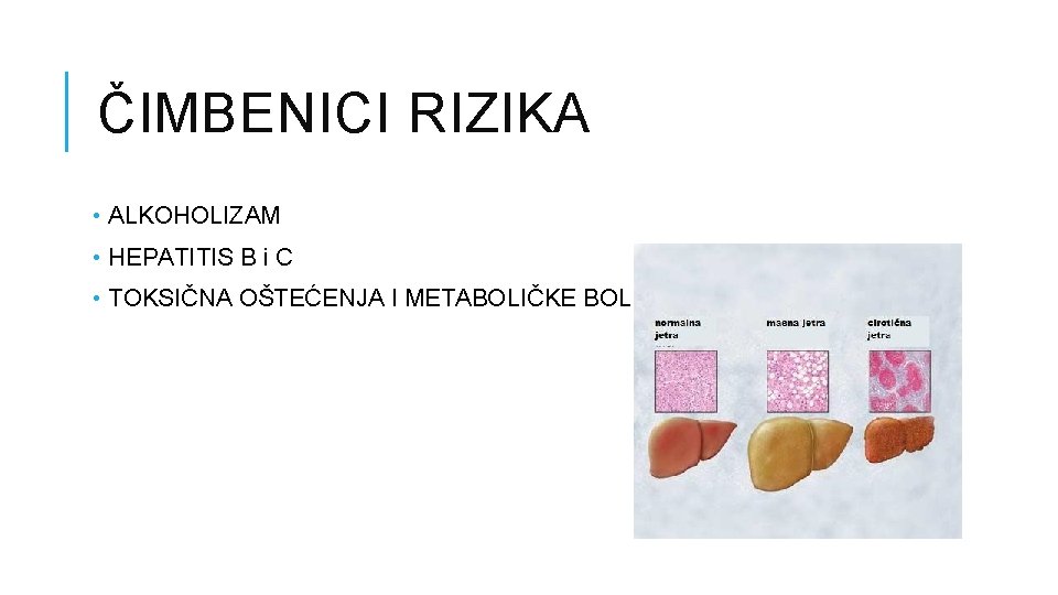 ČIMBENICI RIZIKA • ALKOHOLIZAM • HEPATITIS B i C • TOKSIČNA OŠTEĆENJA I METABOLIČKE