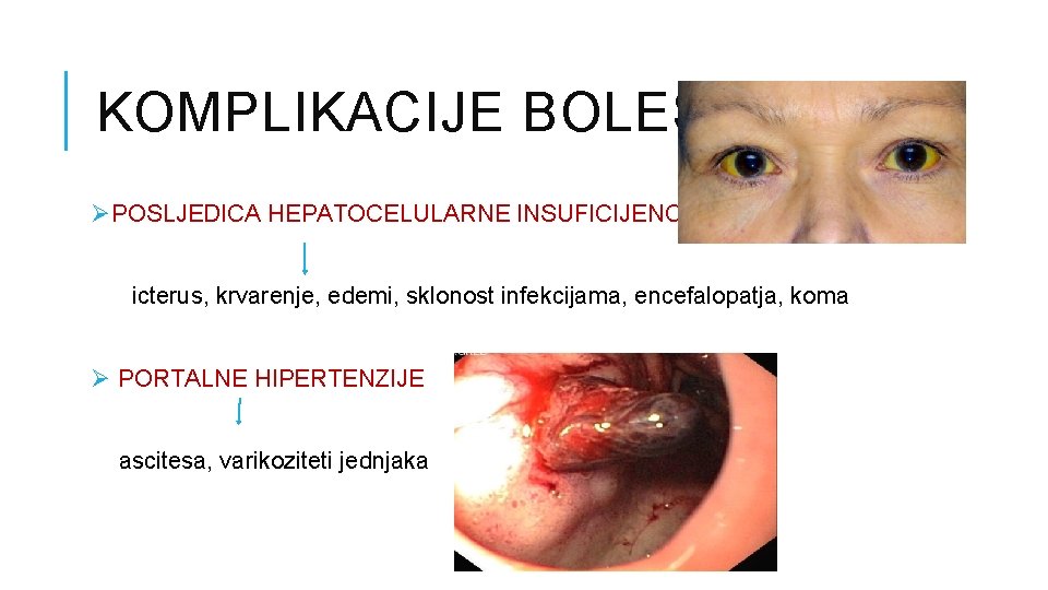 KOMPLIKACIJE BOLESTI ØPOSLJEDICA HEPATOCELULARNE INSUFICIJENCIJE icterus, krvarenje, edemi, sklonost infekcijama, encefalopatja, koma Ø PORTALNE