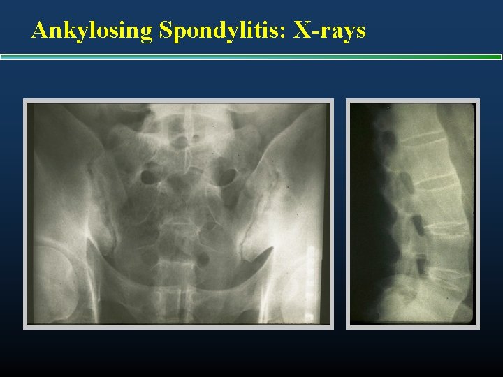 Ankylosing Spondylitis: X-rays 