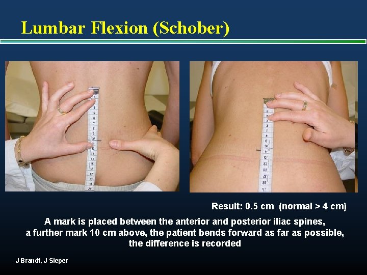 Lumbar Flexion (Schober) Result: 0. 5 cm (normal > 4 cm) A mark is
