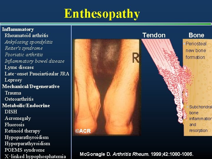 Enthesopathy Inflammatory Rheumatoid arthritis Ankylosing spondylitis Reiter's syndrome Psoriatic arthritis Inflammatory bowel disease Lyme