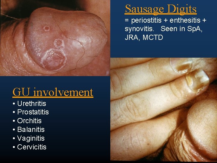 Sausage Digits = periostitis + enthesitis + synovitis. Seen in Sp. A, JRA, MCTD
