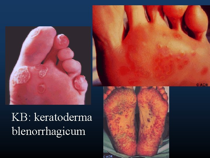 KB: keratoderma blenorrhagicum 