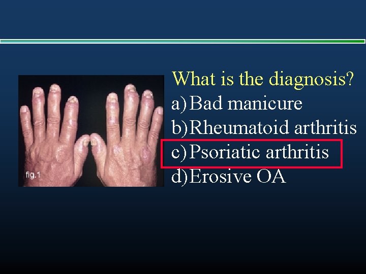 What is the diagnosis? a) Bad manicure b) Rheumatoid arthritis c) Psoriatic arthritis d)