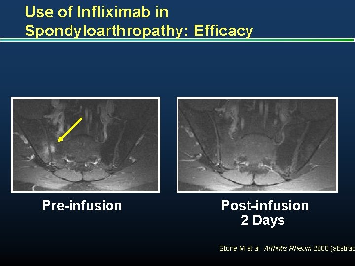 Use of Infliximab in Spondyloarthropathy: Efficacy Pre-infusion Post-infusion 2 Days Stone M et al.