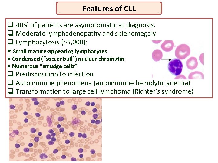 Features of CLL q 40% of patients are asymptomatic at diagnosis. q Moderate lymphadenopathy