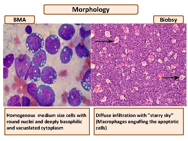 Morphology BMA Homogenous medium size cells with round nuclei and deeply basophilic and vacuolated