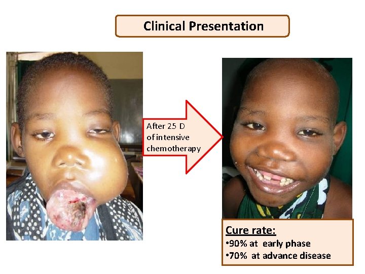 Clinical Presentation After 25 D of intensive chemotherapy Cure rate: • 90% at early