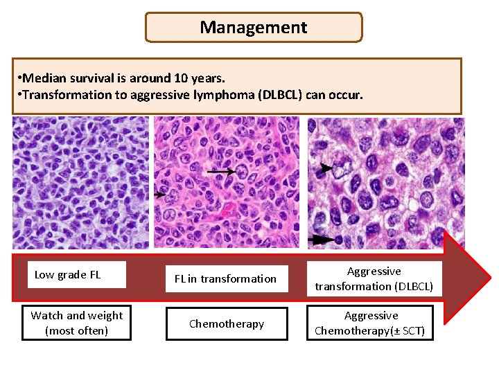 Management • Median survival is around 10 years. • Transformation to aggressive lymphoma (DLBCL)