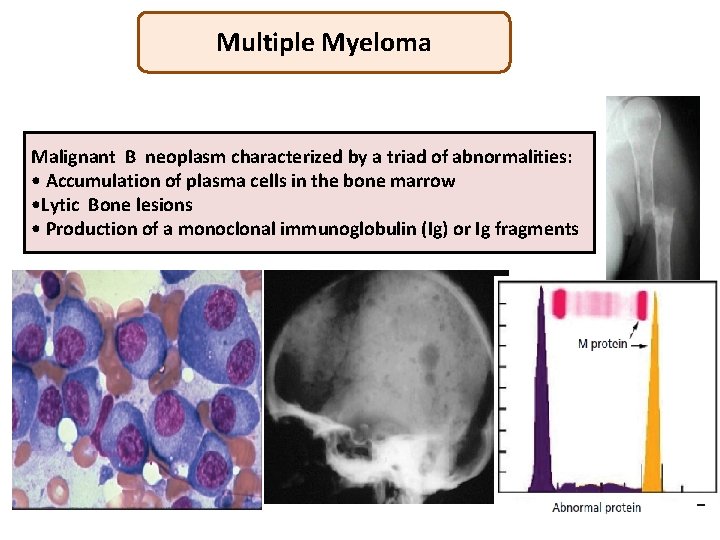 Multiple Myeloma Malignant B neoplasm characterized by a triad of abnormalities: • Accumulation of