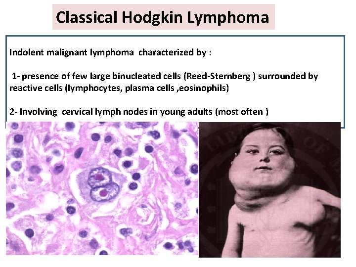 Classical Hodgkin Lymphoma Indolent malignant lymphoma characterized by : 1 - presence of few