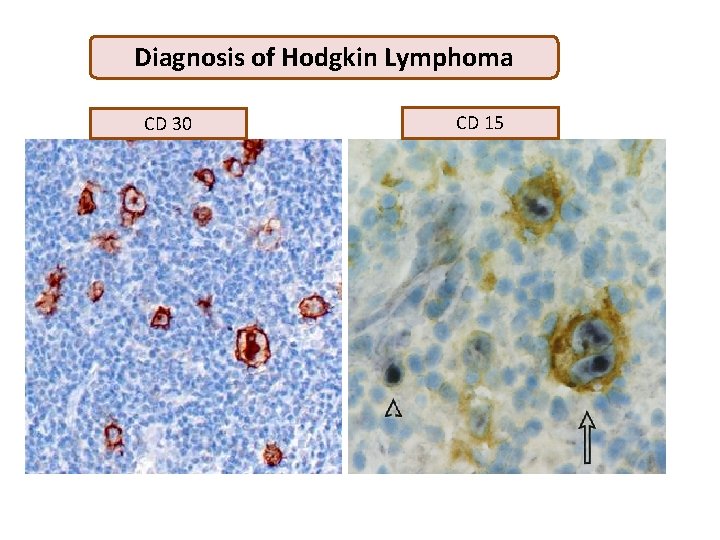 Diagnosis of Hodgkin Lymphoma CD 30 CD 15 