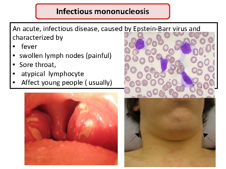 Infectious mononucleosis An acute, infectious disease, caused by Epstein-Barr virus and characterized by •