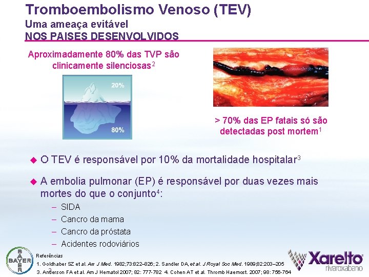 Tromboembolismo Venoso (TEV) Uma ameaça evitável NOS PAISES DESENVOLVIDOS Aproximadamente 80% das TVP são