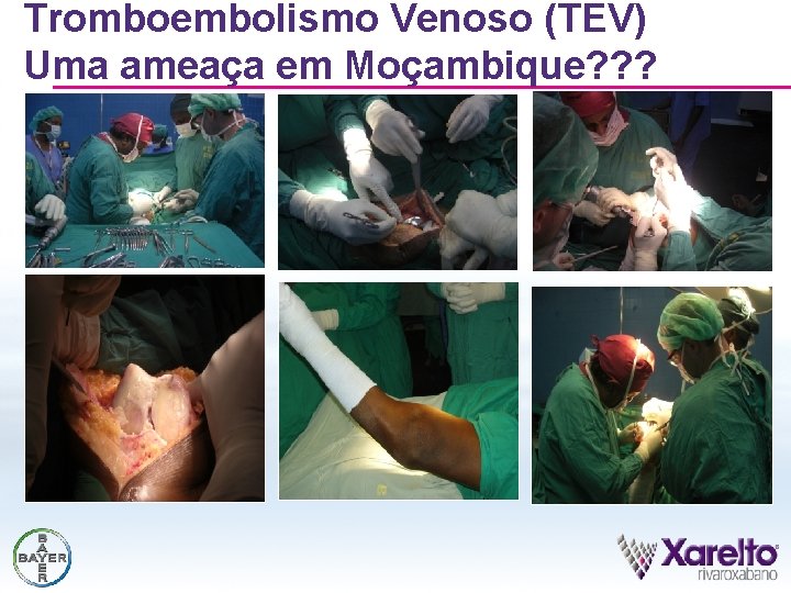 Tromboembolismo Venoso (TEV) Uma ameaça em Moçambique? ? ? 