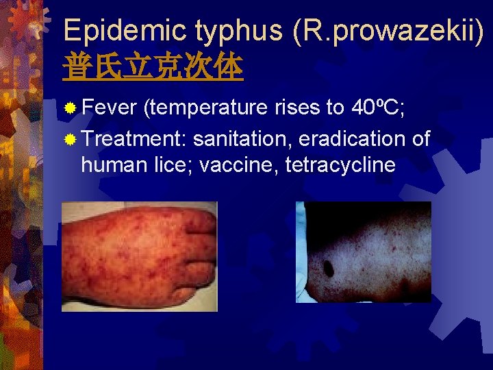 Epidemic typhus (R. prowazekii) 普氏立克次体 ® Fever (temperature rises to 40ºC; ® Treatment: sanitation,