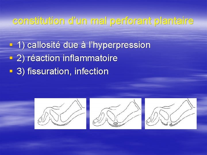 constitution d’un mal perforant plantaire § § § 1) callosité due à l’hyperpression 2)
