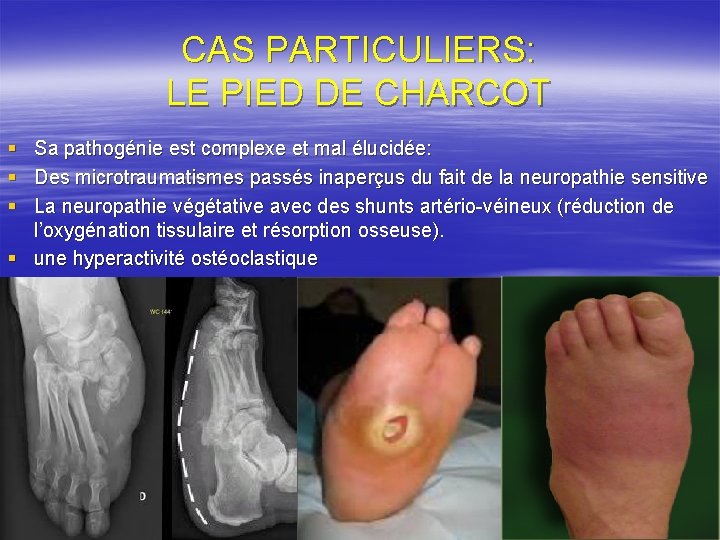 CAS PARTICULIERS: LE PIED DE CHARCOT § § § Sa pathogénie est complexe et