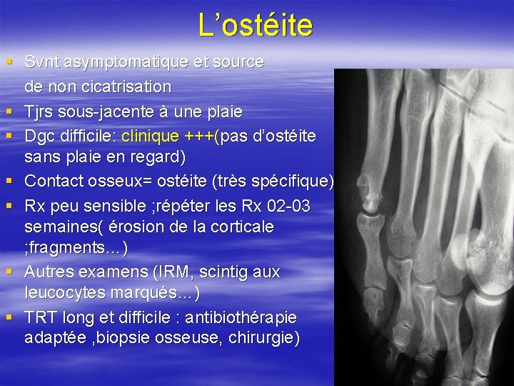 L’ostéite § Svnt asymptomatique et source de non cicatrisation § Tjrs sous-jacente à une