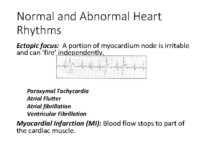 Normal and Abnormal Heart Rhythms Ectopic focus: A portion of myocardium node is irritable