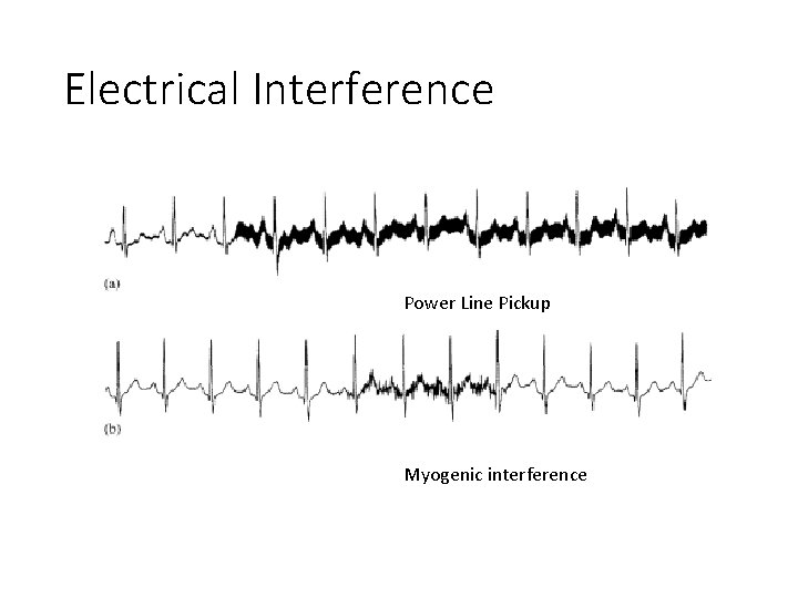Electrical Interference Power Line Pickup Myogenic interference 