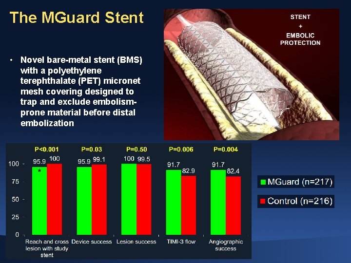 The MGuard Stent • Novel bare-metal stent (BMS) with a polyethylene terephthalate (PET) micronet