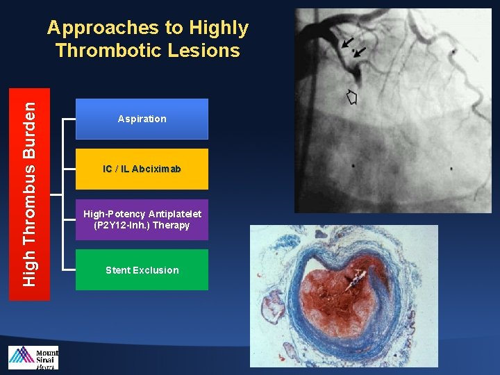 High Thrombus Burden Approaches to Highly Thrombotic Lesions Aspiration IC / IL Abciximab High-Potency
