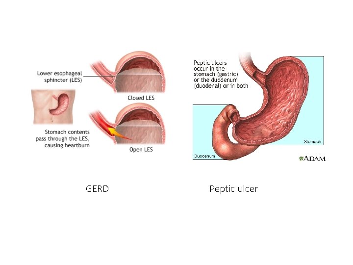 GERD Peptic ulcer 