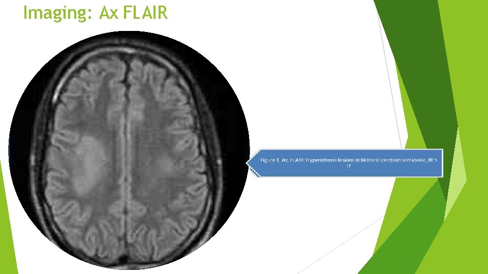 Imaging: Ax FLAIR Imaging: Ax FLAIR