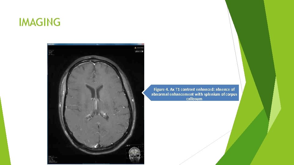 IMAGING Figure 4. Ax T 1 contrast enhanced: absence of abnormal enhancement with splenium IMAGING Figure 4. Ax T 1 contrast enhanced: absence of abnormal enhancement with splenium