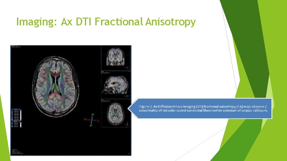 Imaging: Ax DTI Fractional Anisotropy Imaging: Ax DTI Fractional Anisotropy