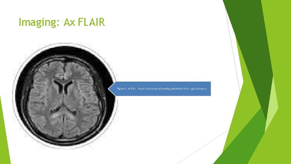Imaging: Ax FLAIR Imaging: Ax FLAIR