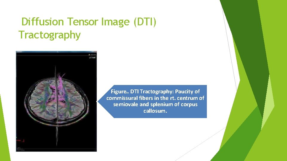 Diffusion Tensor Image (DTI) Tractography Figure. DTI Tractography: Paucity of commissural fibers in the Diffusion Tensor Image (DTI) Tractography Figure. DTI Tractography: Paucity of commissural fibers in the