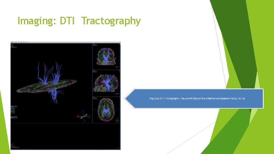 Imaging: DTI Tractography Imaging: DTI Tractography