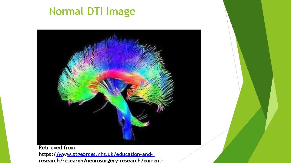 Normal DTI Image Retrieved from https: //www. stgeorges. nhs. uk/education-andresearch/neurosurgery-research/current- Normal DTI Image Retrieved from https: //www. stgeorges. nhs. uk/education-andresearch/neurosurgery-research/current-