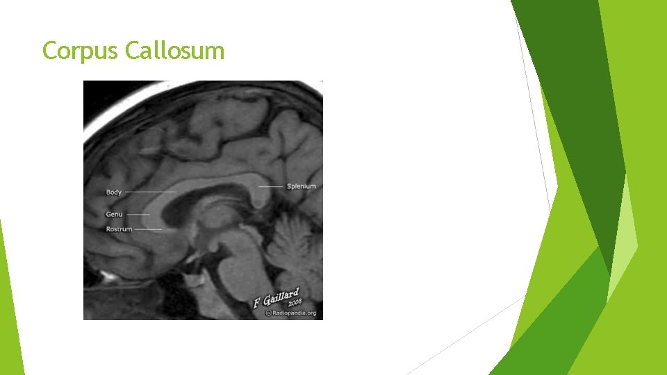 Corpus Callosum Corpus Callosum
